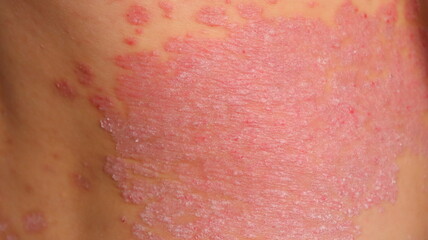 Fototapeta premium psoriasis, chronic non-infectious skin disease, autoimmune disease, red spots on the body