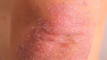 psoriasis, chronic non-infectious skin disease, autoimmune disease, red spots on the body