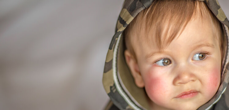 Atopic dermatitis eczema in baby.Condition that causes the skin to become red,dry,sore,itchy and cracked.Atopic eczema most often affects face in children. - Powered by Adobe