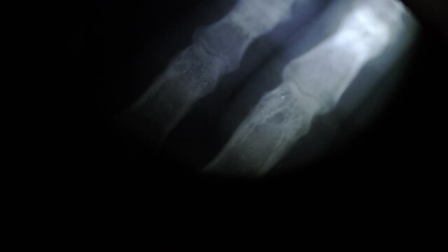 Doctor Radiologist Examining X-Ray Image of Hands Wrists with Flashlight POV