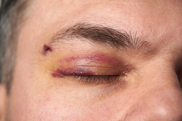 Naklejka premium close view of a black eye, man's face with a hematoma
