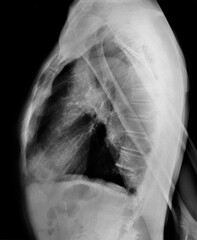 x-ray of the human chest in a lateral projection