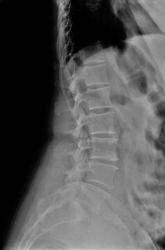 radiography of the lumbar spine in a lateral projection