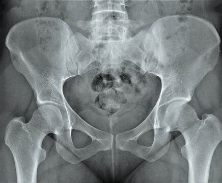 x-ray of the adult pelvis