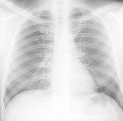 chest x-ray of an adult .diagnosis of pneumonia