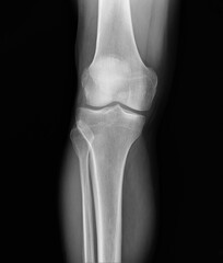 x-ray of the knee joint of an adult in a direct projection
