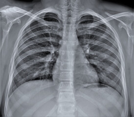 radiography of the chest.diagnosis of lung diseases.pneumonia