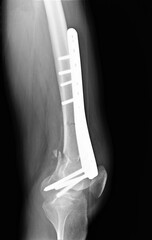 x ray with a fracture of the femoral condyles fixed plate with screws and bandages on the knee joint