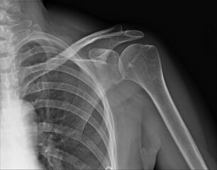 x-ray of the shoulder joint of an adult in a direct projection