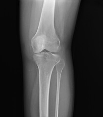 x-ray of the normal knee joint.medical diagnostics