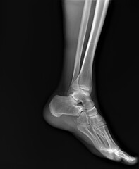 the x-ray shows an adult's ankle joint