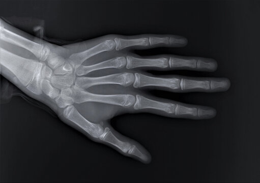 radiograph of human hand bones