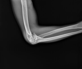 radiograph of the elbow joint of an adult with a fracture of the condyles of the humerus