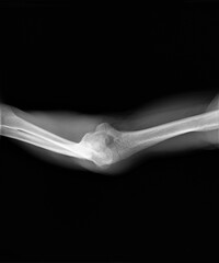 Obraz premium radiograph of the elbow joint of an adult with a fracture of the condyles of the humerus