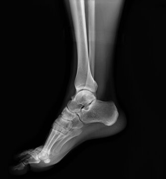 the x-ray shows an adult's ankle joint