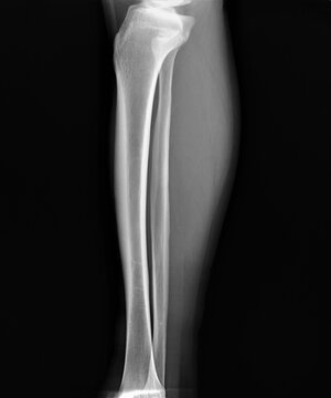 radiograph of the leg bones of an adult