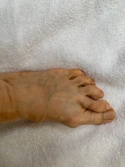 Foot/toes deformed with bunion, hammer toes, bone
Spur