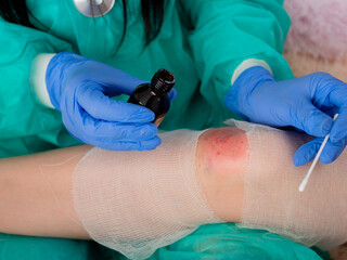 Woman doctor in medical gloves cleans and handles with an antiseptic wound on the knee of a teenage...