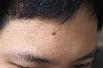 Black moles and skin texture with acne on Asian male forehead for aesthetic and beauty concept