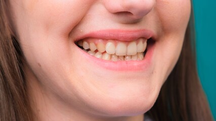 female Yellow teeth, fluorosis. Smokers problem teeth caused by fluoride, smoking, or coffee. Brown tooth enamel due to illness and medicine. Natural photo.