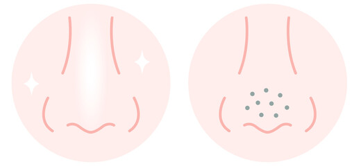 鼻の毛穴　ビフォアアフター