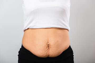 Close up of Asian mother woman showing stretch mark loose lower abdomen skin she fat after...