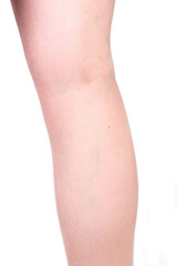 Varicose veins on the back of the female leg.