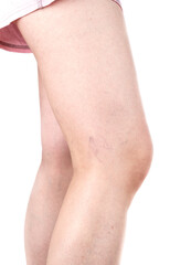 Female legs with varicose veins. Healthy lifestyle.