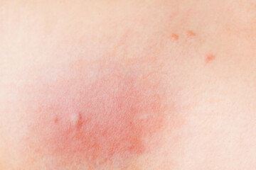 Fototapeta premium Skin texture, allergy to insect bites, redness, swelling. Skin allergic reactions