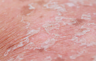 textured background with scales of dead skin cells with cracks and redness after sunburn come off the body