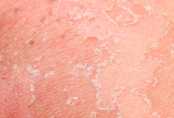 textured background with scales of dead skin cells with redness and pigmentation after sunburn are detached from the body