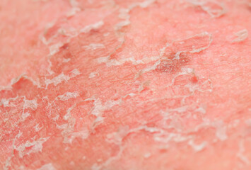 background with the texture of irritated reddened skin with flaking scales and cracks from sunburn and allergies on the human body