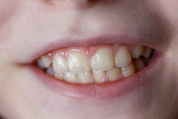 Close up portrait of 9 years old girl with white teeth