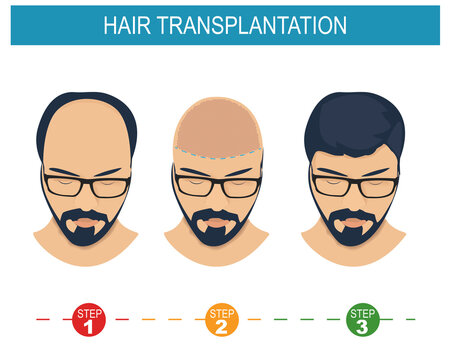 Hair transplantation surgery 4 steps infographic