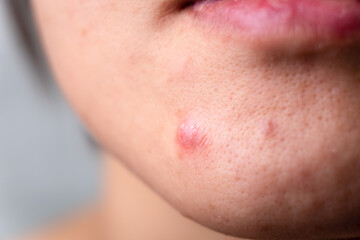 acne on girl face. skin problem.