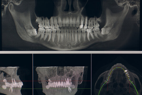 X-ray of the jaw in the dental clinic.