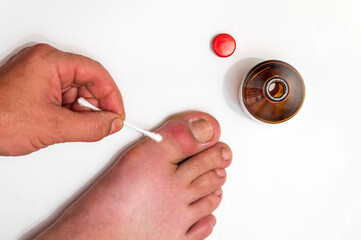 Gout on the big toe treatment with therapeutic ointment