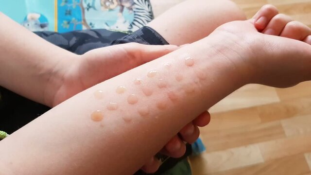 Slow Motion. Allergy to flowering plants. Laboratory research. Allergy tests. The boy holds a hand with allergy tests. Waiting for a result