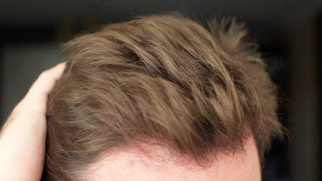 Human hair. Hair problems of a man-dermatitis dandruff hair loss