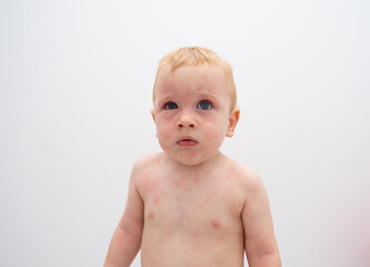 Toddler with severe allergic reaction on face and body. swollen skin