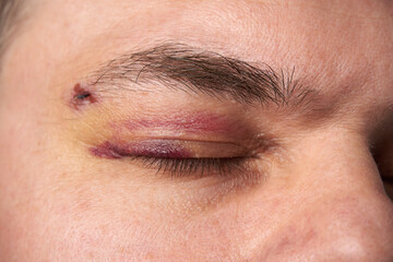Naklejka premium close view of a black eye, man's face with a hematoma