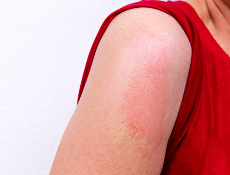 Asian woman has red rash on her shoulder tip