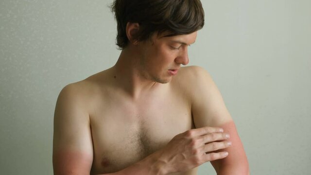 young man touches the burned skin of his hands and winces in pain, sunburn without protection