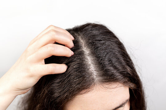 The woman scratches her head with her hand, showing a parting of dark hair with dandruff. Close up. The view from the top. White background. The concept of dandruff and pediculosis