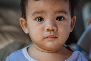portrait of asian baby with skin rashes from allergies or irritation and itchy