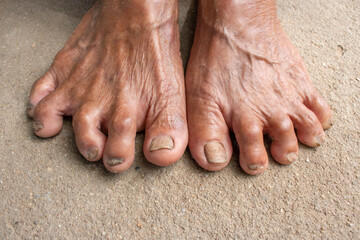 Foot Seniors. dirty feet on mortar. toenail fungus. - obrazy, fototapety, plakaty