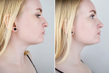 Photos before and after plastic surgery to correct the nasal septum. A woman who has had...
