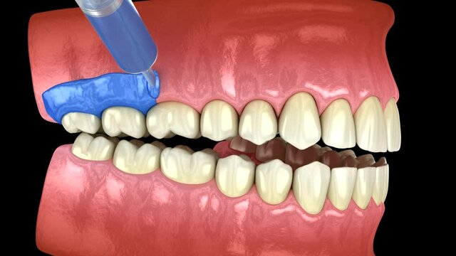 Proffesioinal teeth whitening, light-activation on tooth bleaching. 3D animation concept.