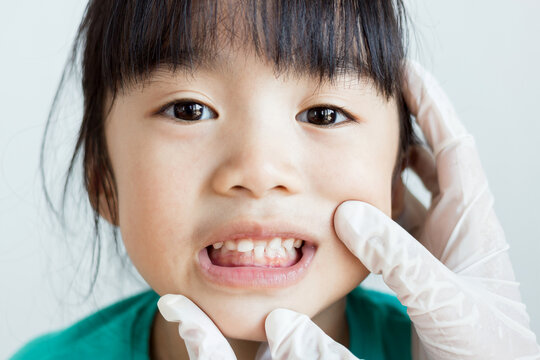 asian child has crowding tooth has check by dentist
