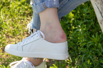 Callus after wearing new white leather sneakers